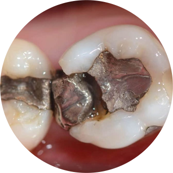 Broken Fillings Image