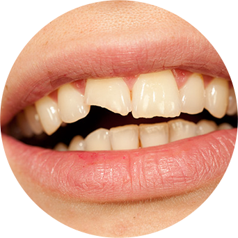 Chipped/Crooked Teeth Image