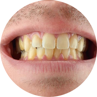 Dull Tooth Color Image
