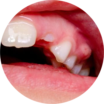 Gum Disease Image