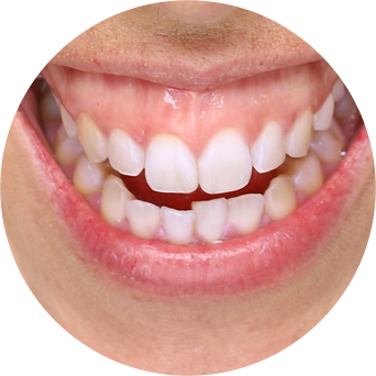 Gummy Smiles Image