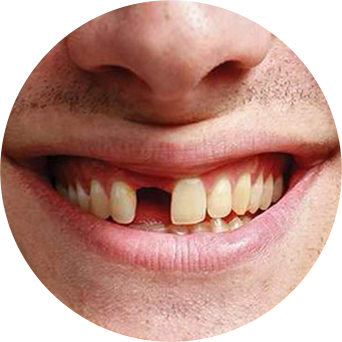 Missing Teeth Image