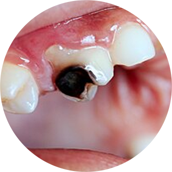 Recurring Tooth Decay Image