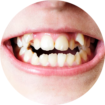 Uneven Tooth Alignment Image
