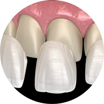 Veneer/Implant Protection Image