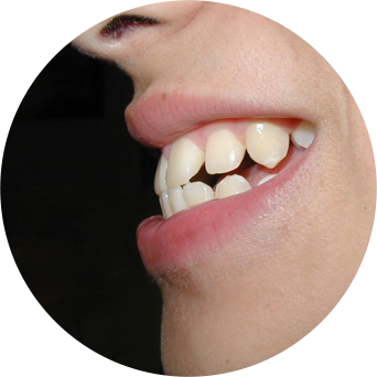 Overbite Image