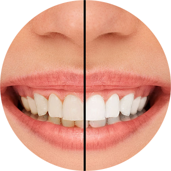 Smile Transformation Image