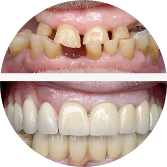 Full Mouth Rehabilitation Image