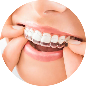Invisalign/Braces Image