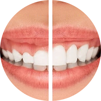 Gum Contouring & Reshaping Image