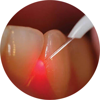Laser Gum Therapy Image