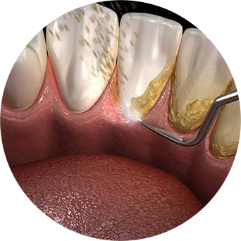 Periodontal Cleaning Image