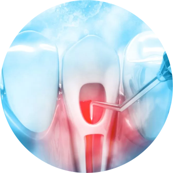 Root Canal Disinfection Image