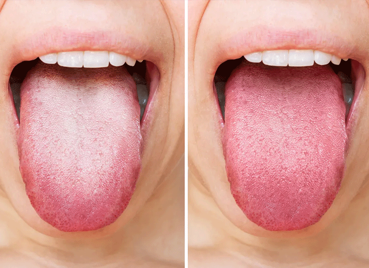 Tongue Coating