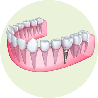 Keyhole Flapless Image