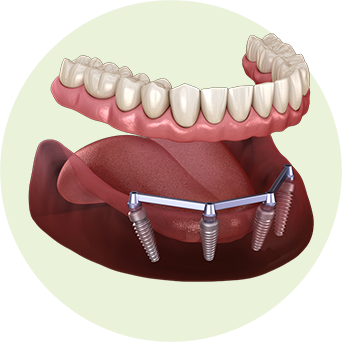 Full Mouth Bridge Image