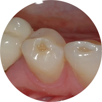 Worn Teeth Image