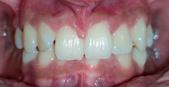 Overbite Image