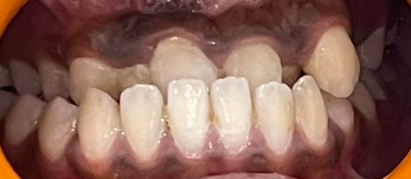 Underbite Image